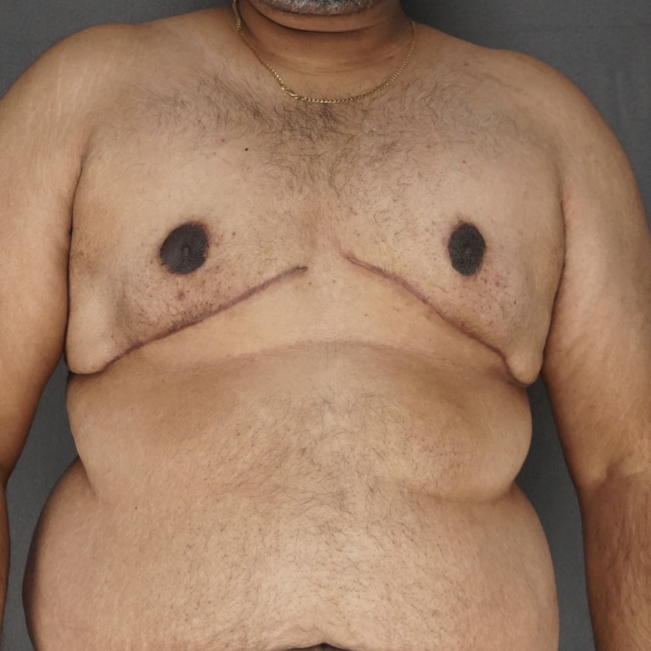 Gynecomastia Surgery after — Dr. Marc Elkowitz