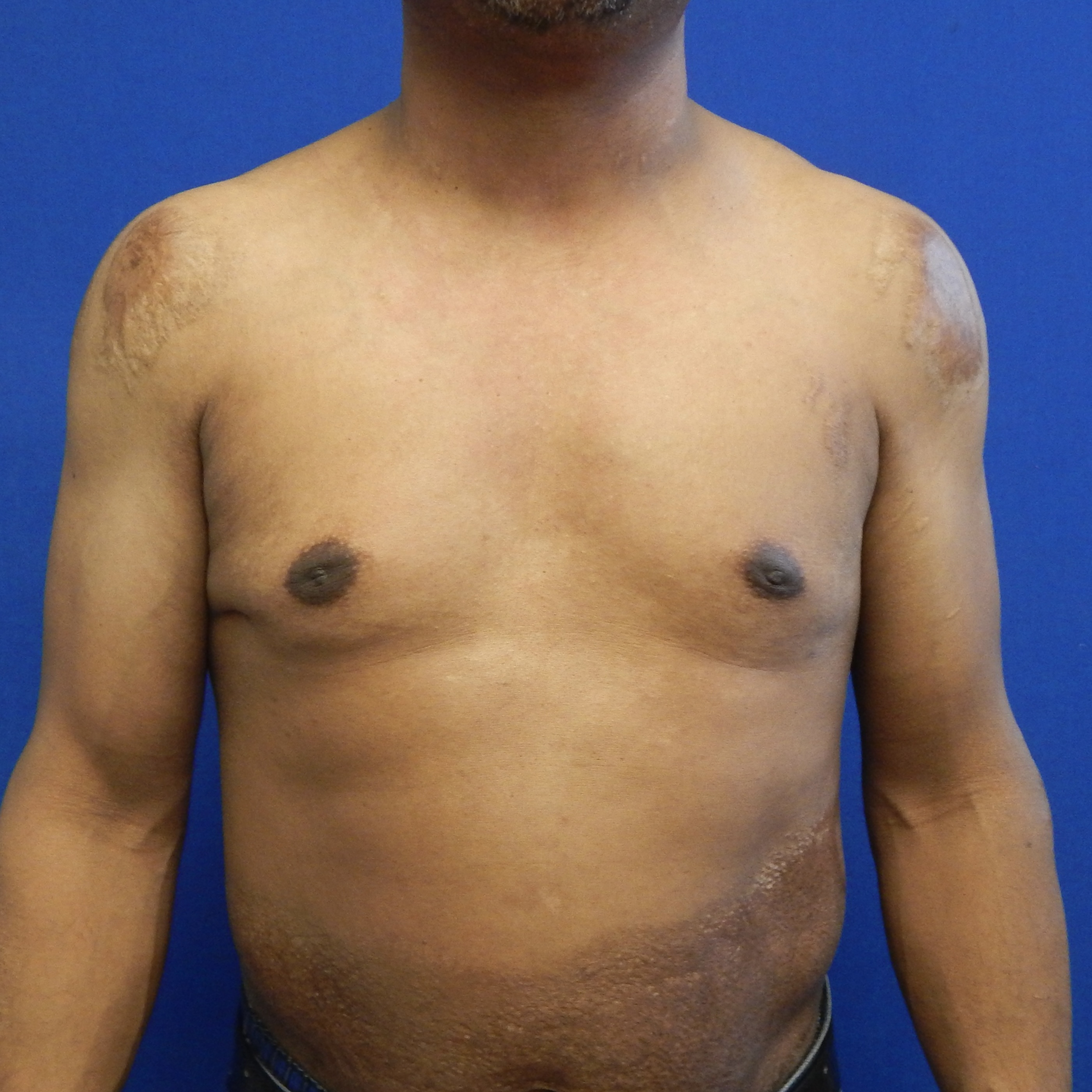 Gynecomastia Surgery after — Dr. Marc Elkowitz