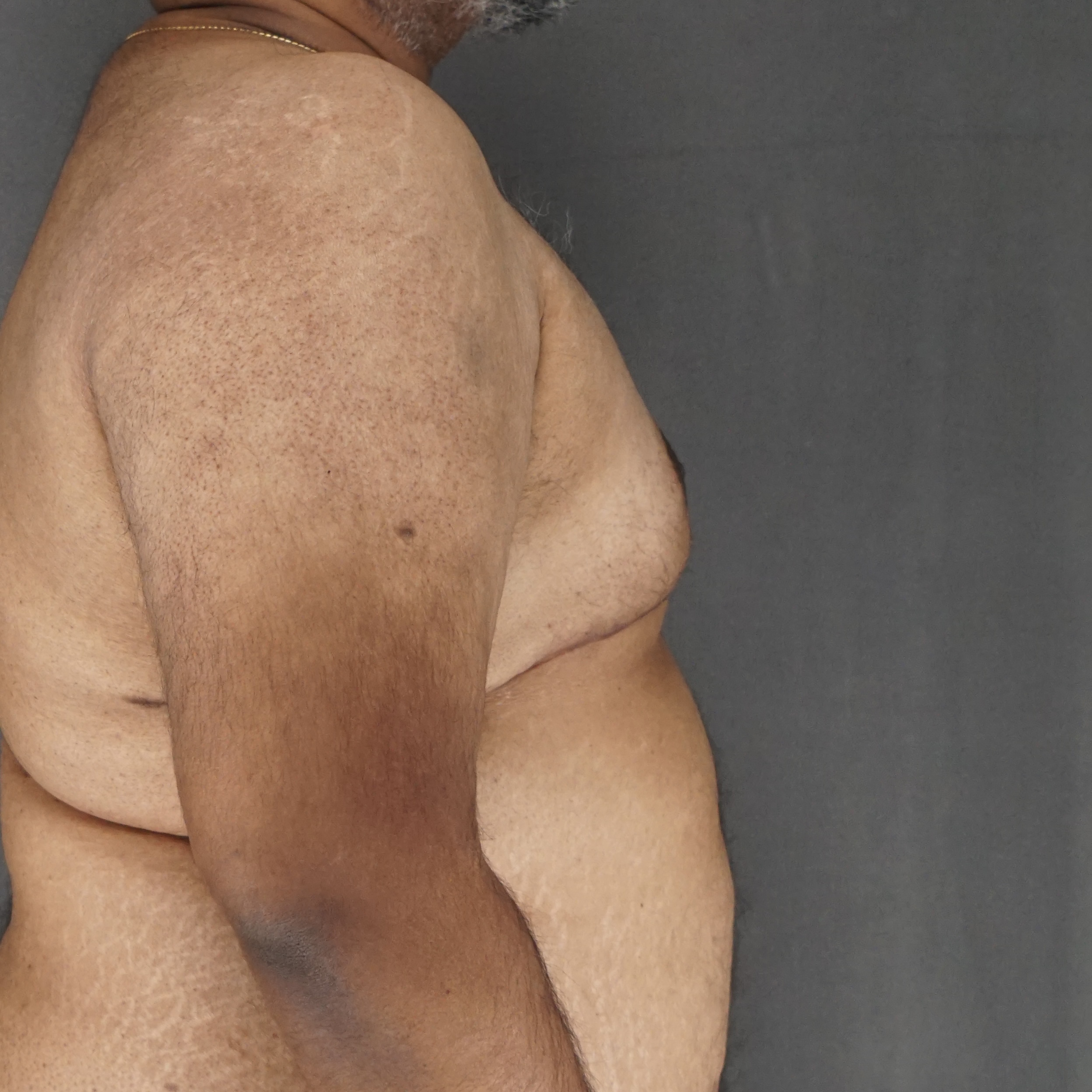 Gynecomastia Surgery after — Dr. Marc Elkowitz