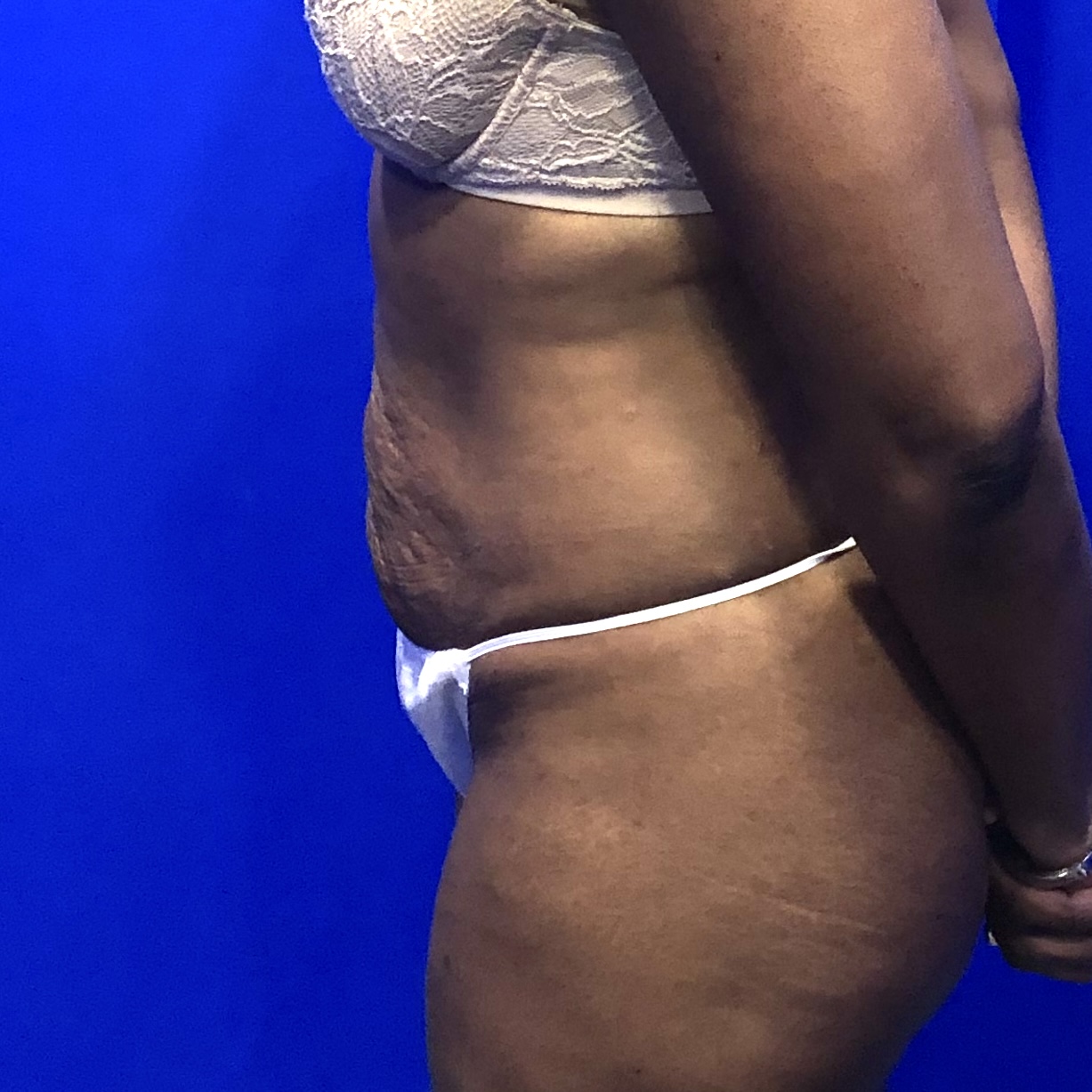 Procedure before and after - before