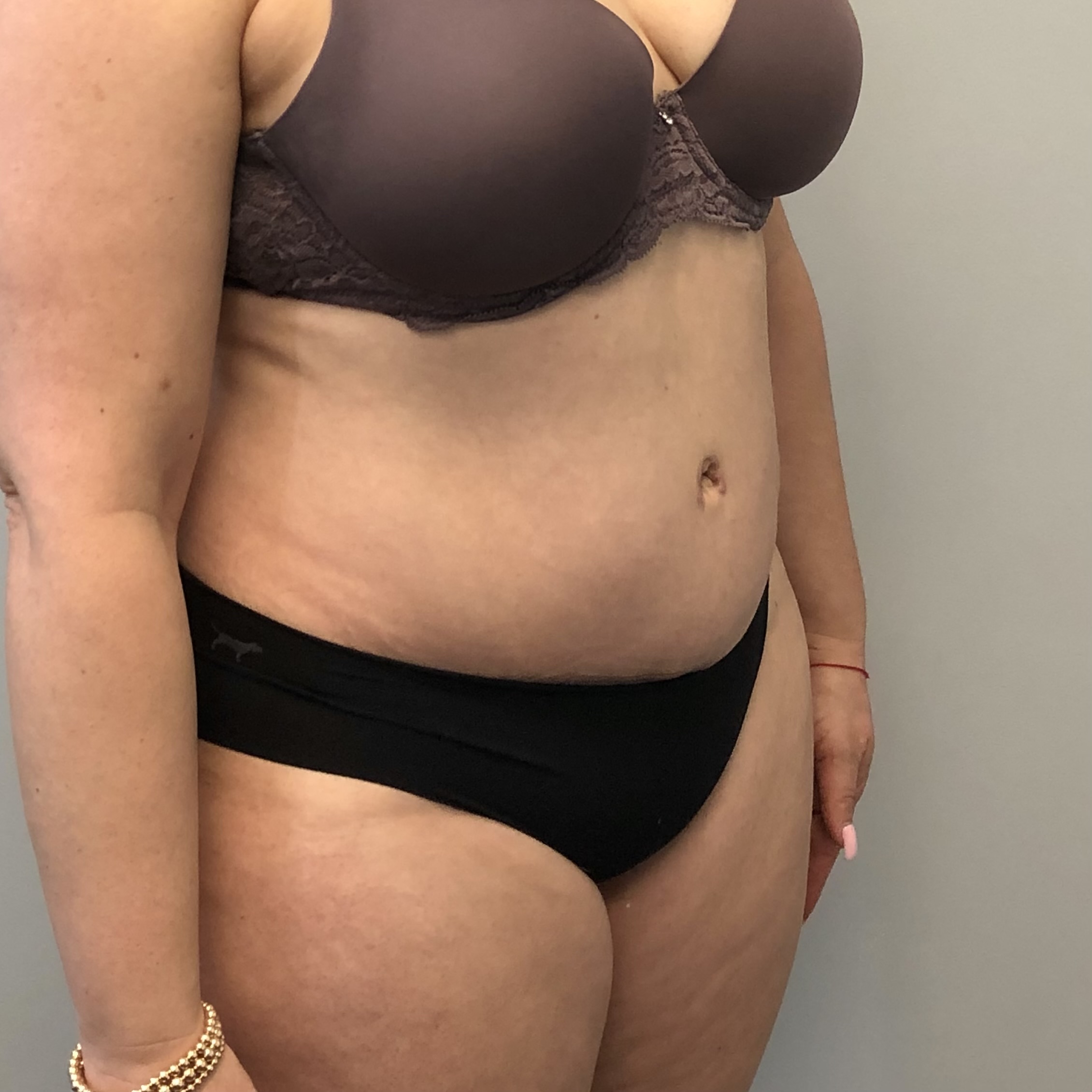 Procedure before and after - after