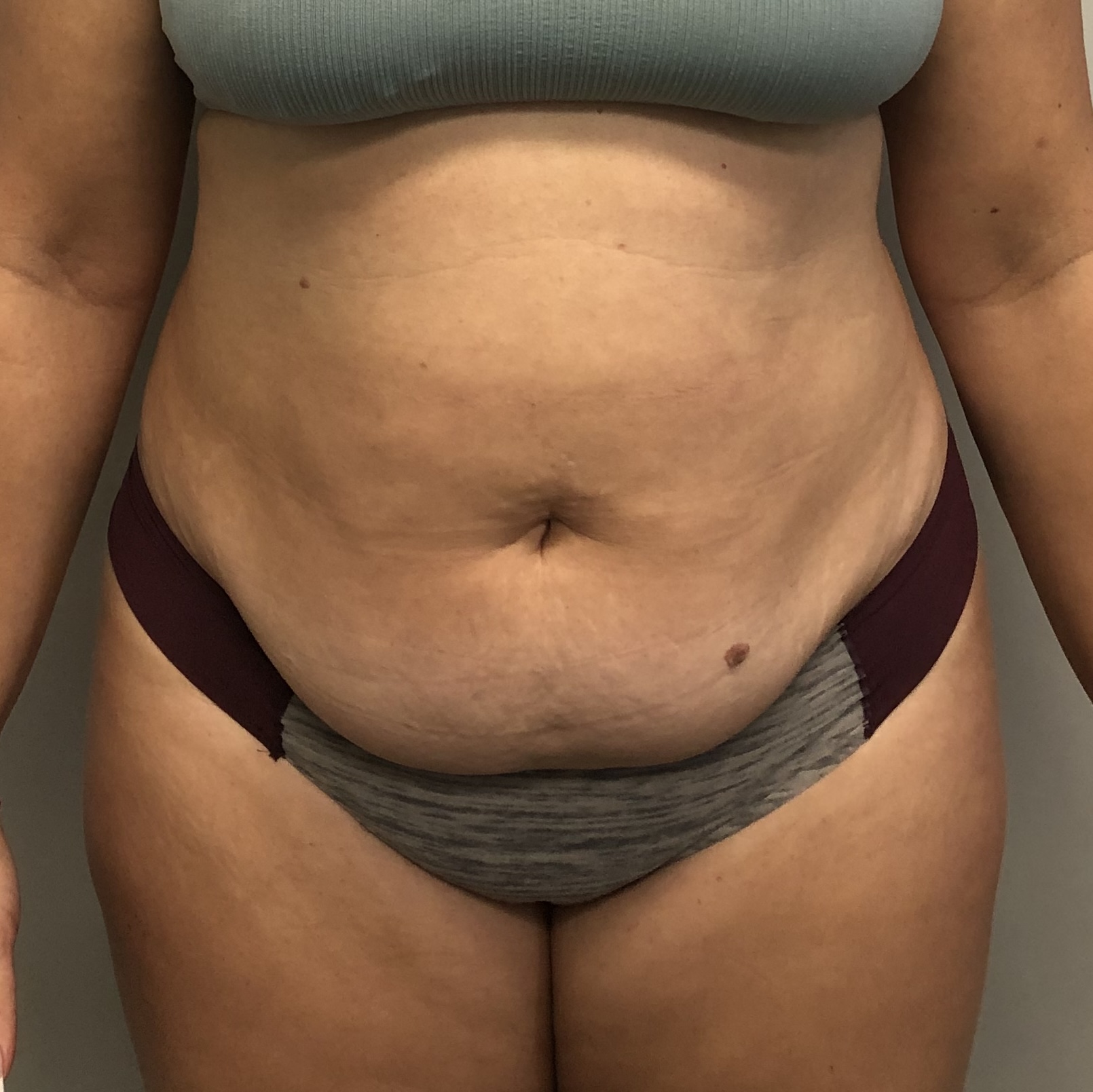 Procedure before and after - before