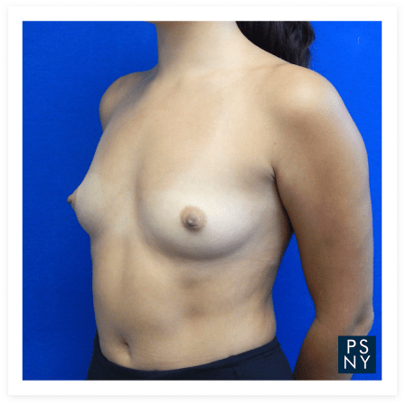 Procedure before and after - before