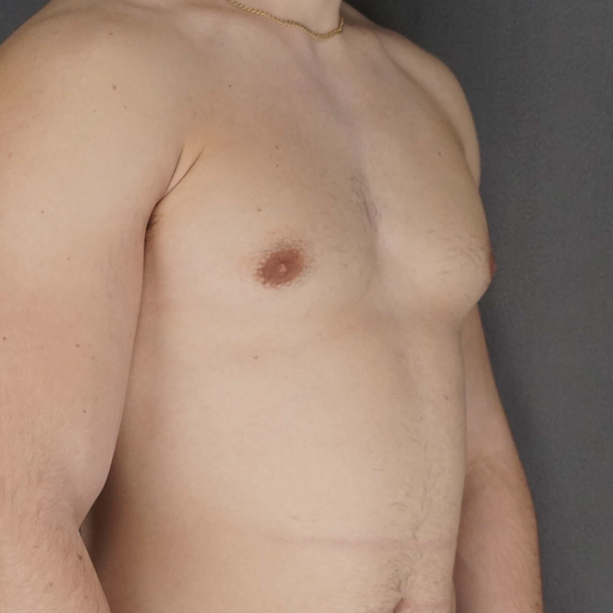 Gynecomastia Surgery before — Dr. Marc Elkowitz