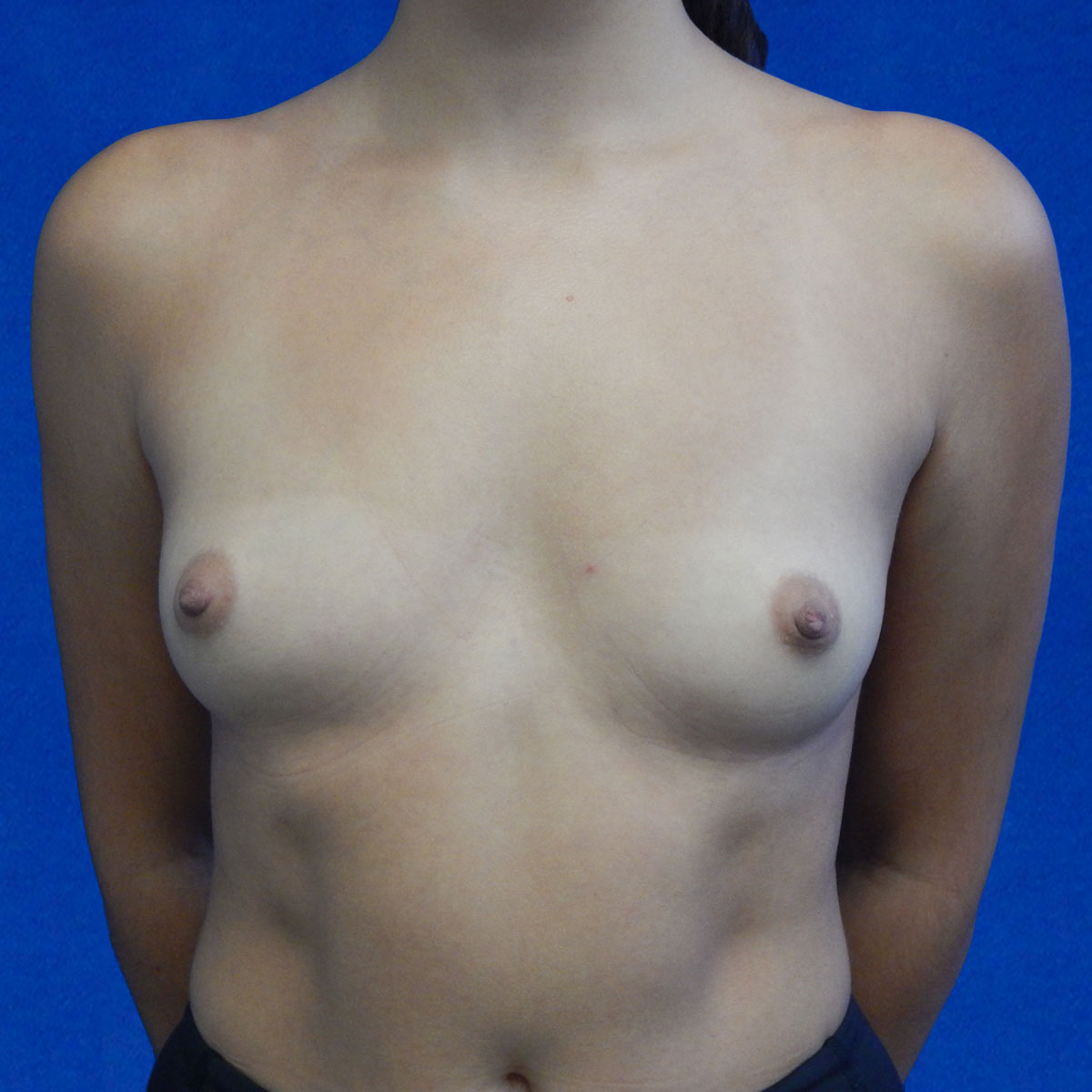 Procedure before and after - before