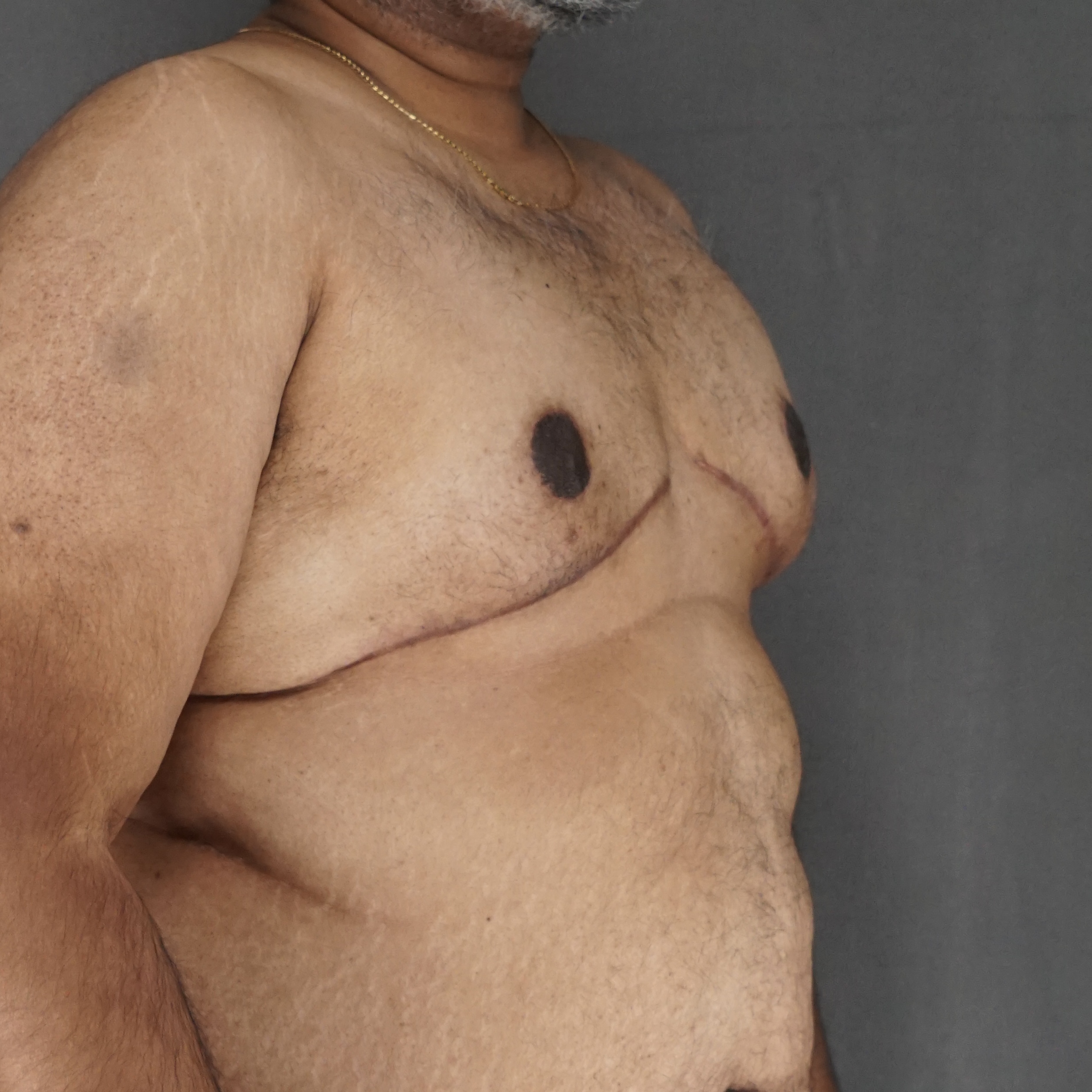 Gynecomastia Surgery after — Dr. Marc Elkowitz