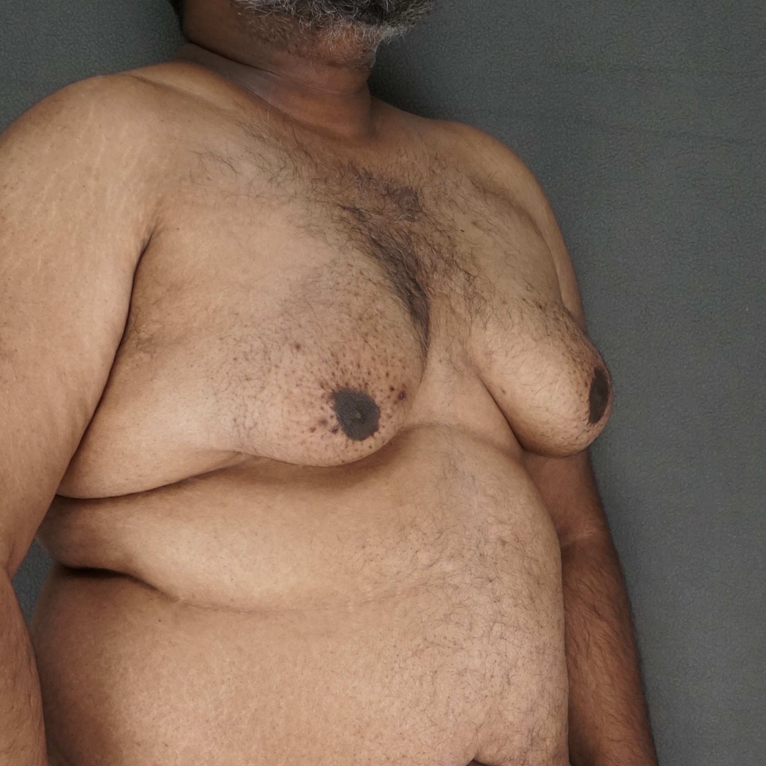 Gynecomastia Surgery before — Dr. Marc Elkowitz