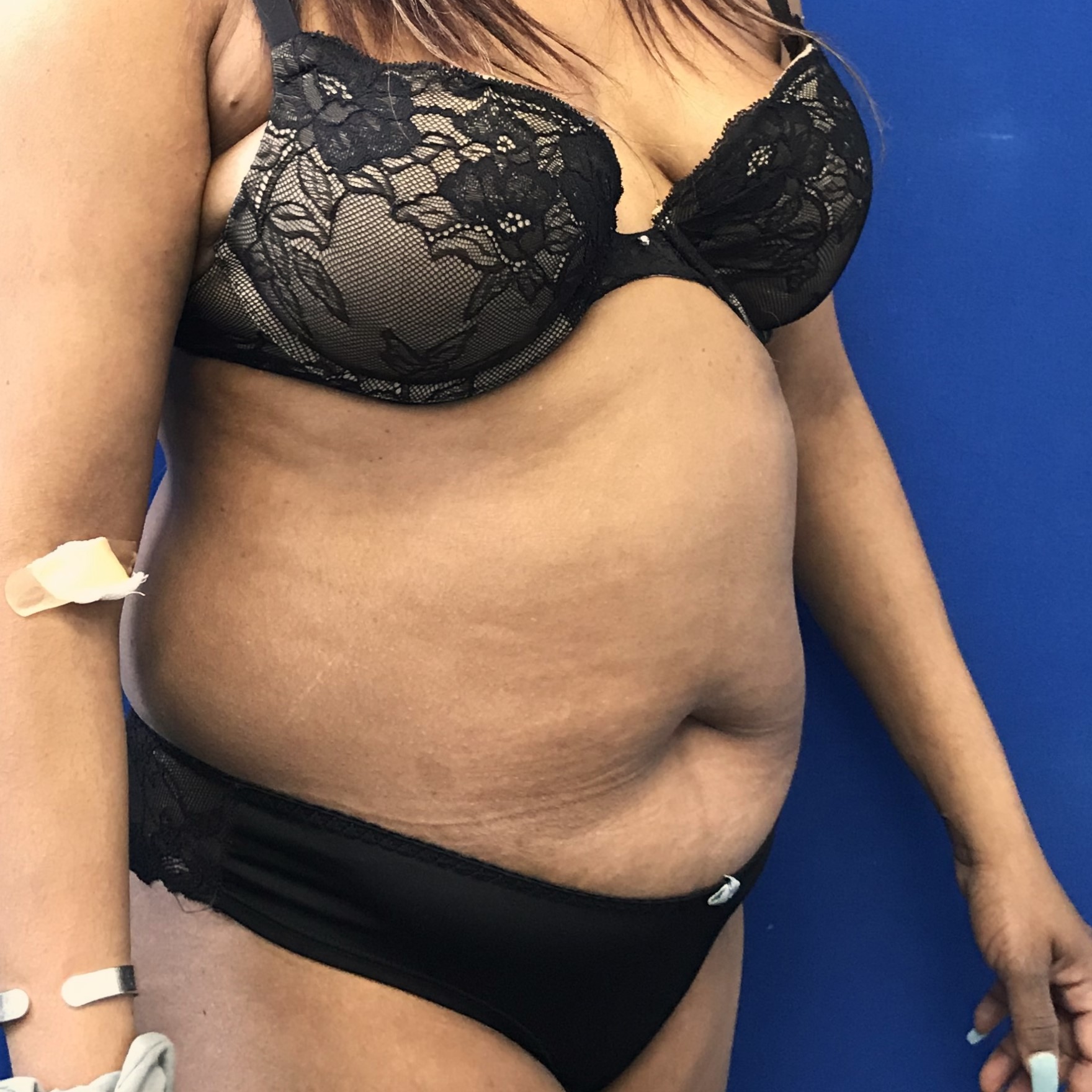 Procedure before and after - before
