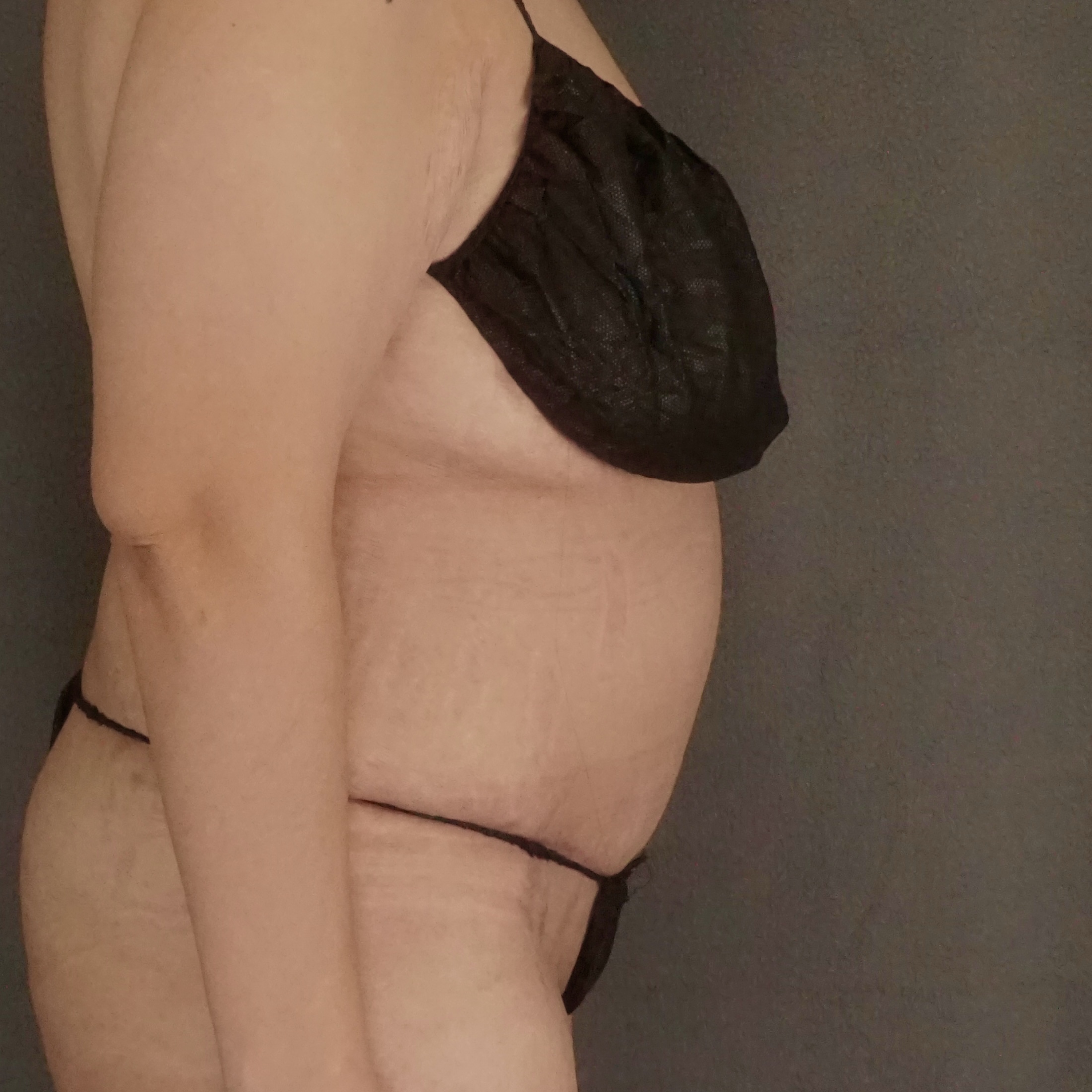 Procedure before and after - after