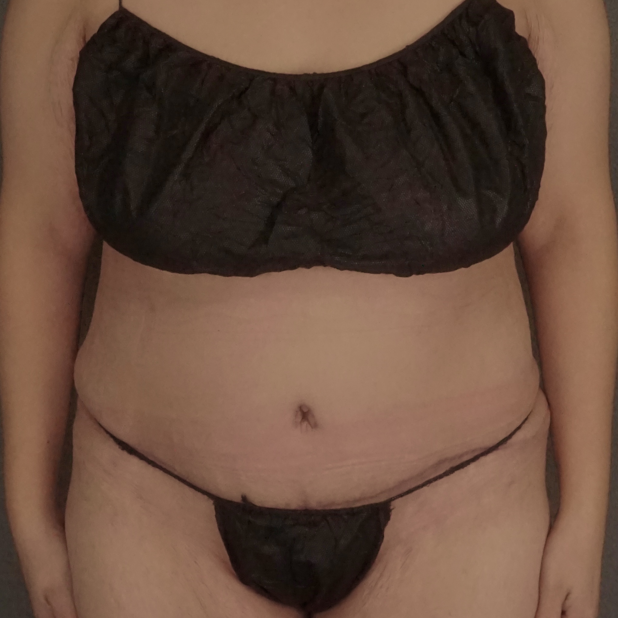 Procedure before and after - after