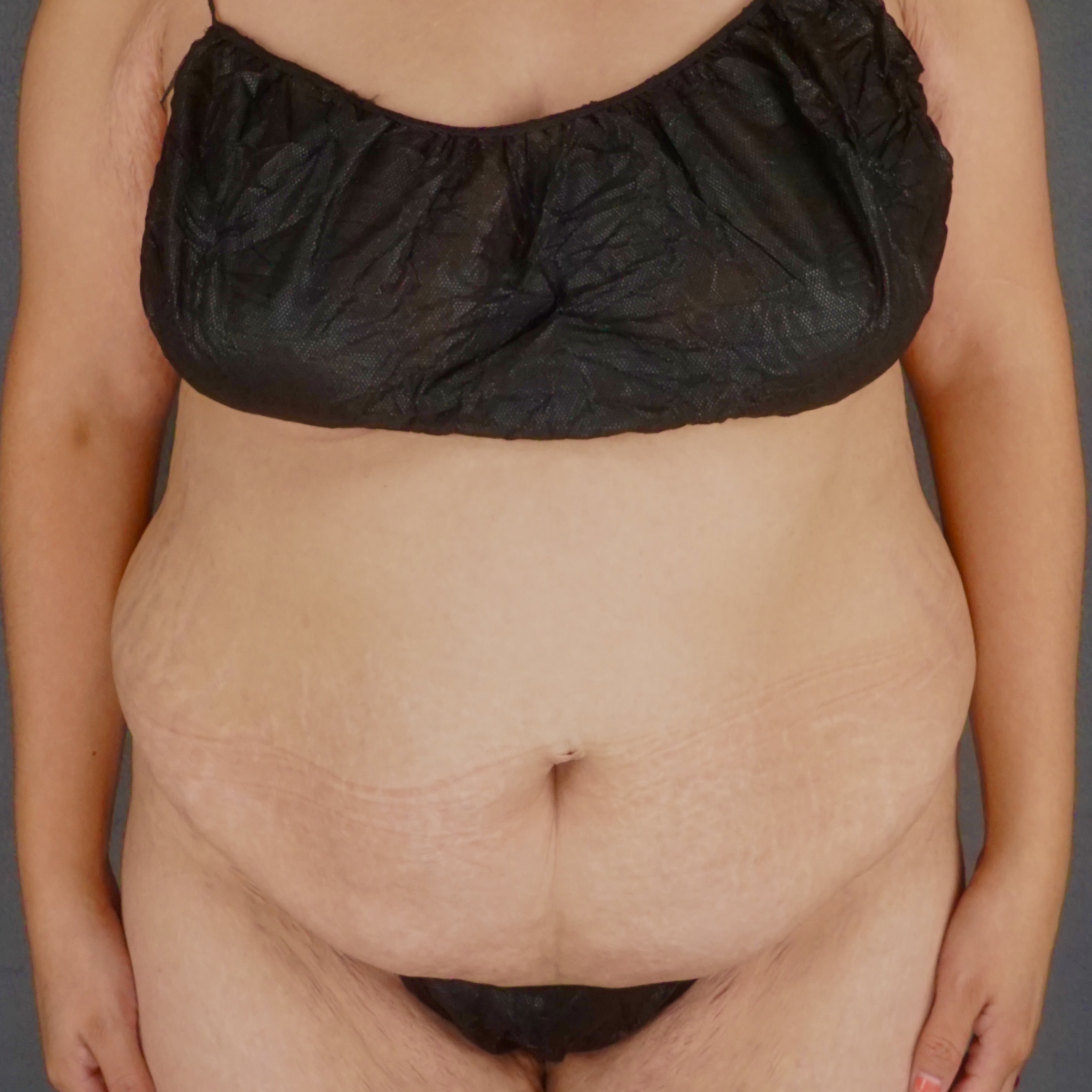 Procedure before and after - before