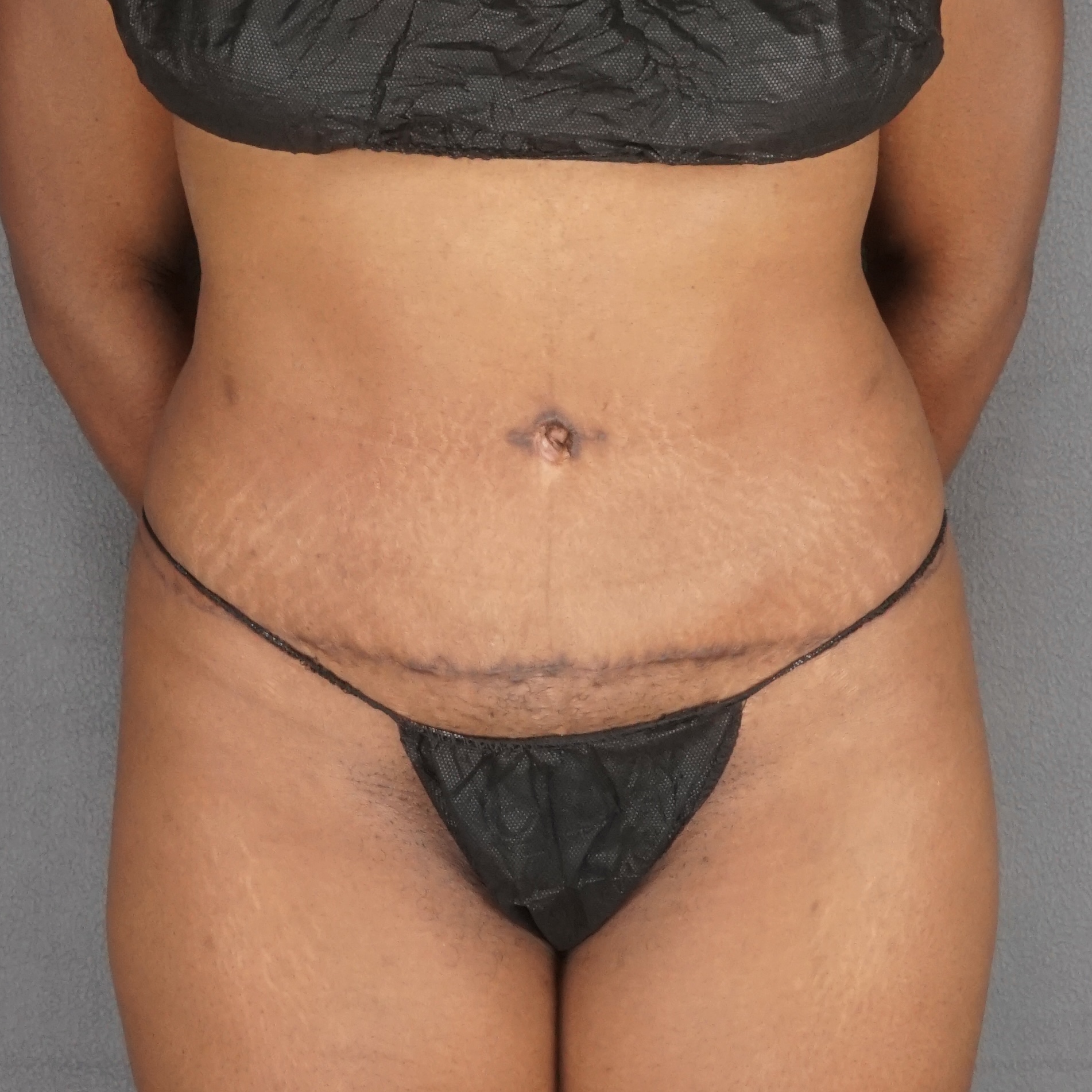 Procedure before and after - after
