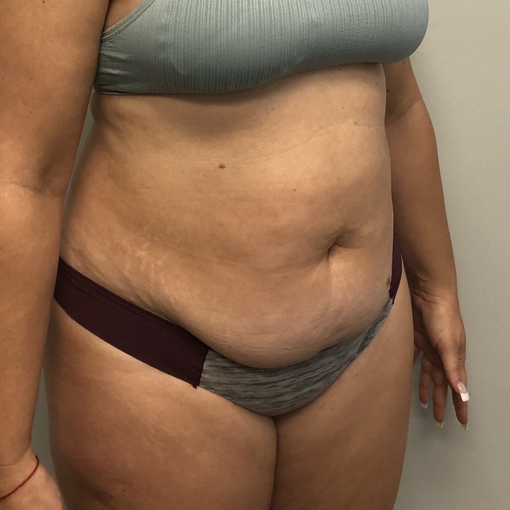 Procedure before and after - before