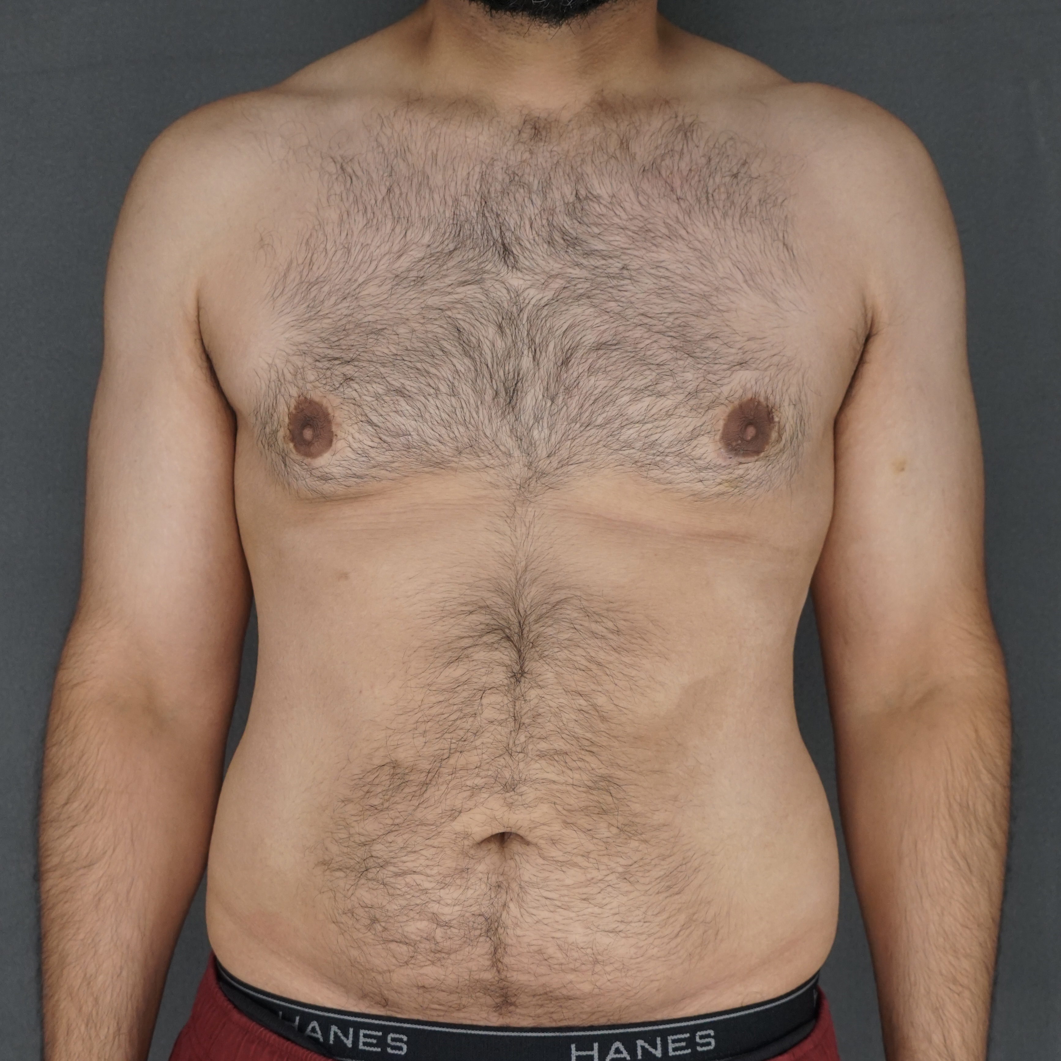 Gynecomastia Surgery after — Dr. Marc Elkowitz