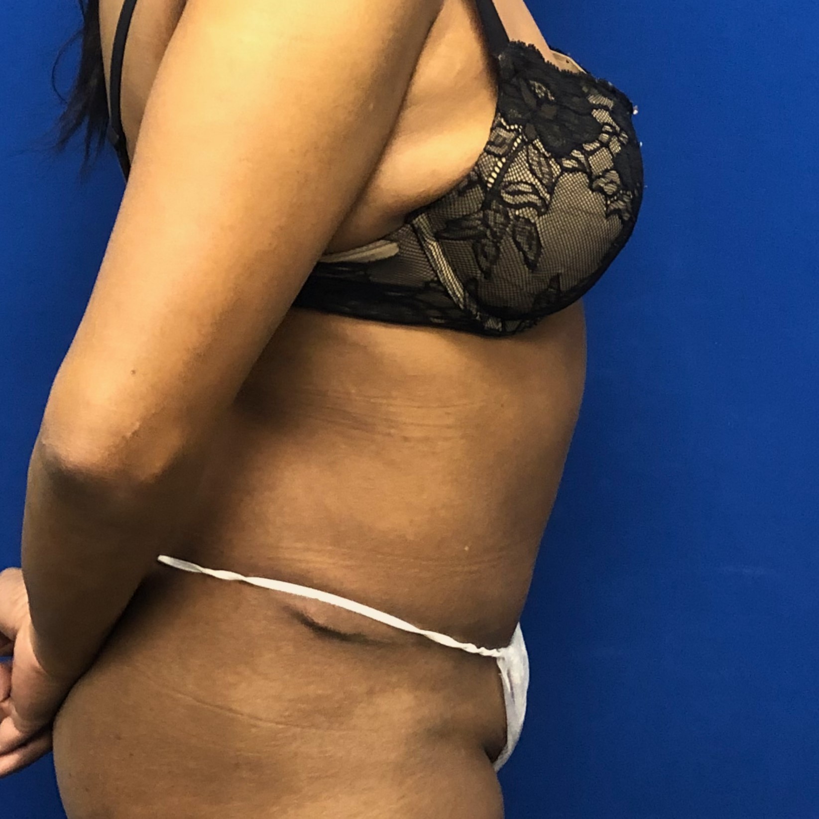 Procedure before and after - after