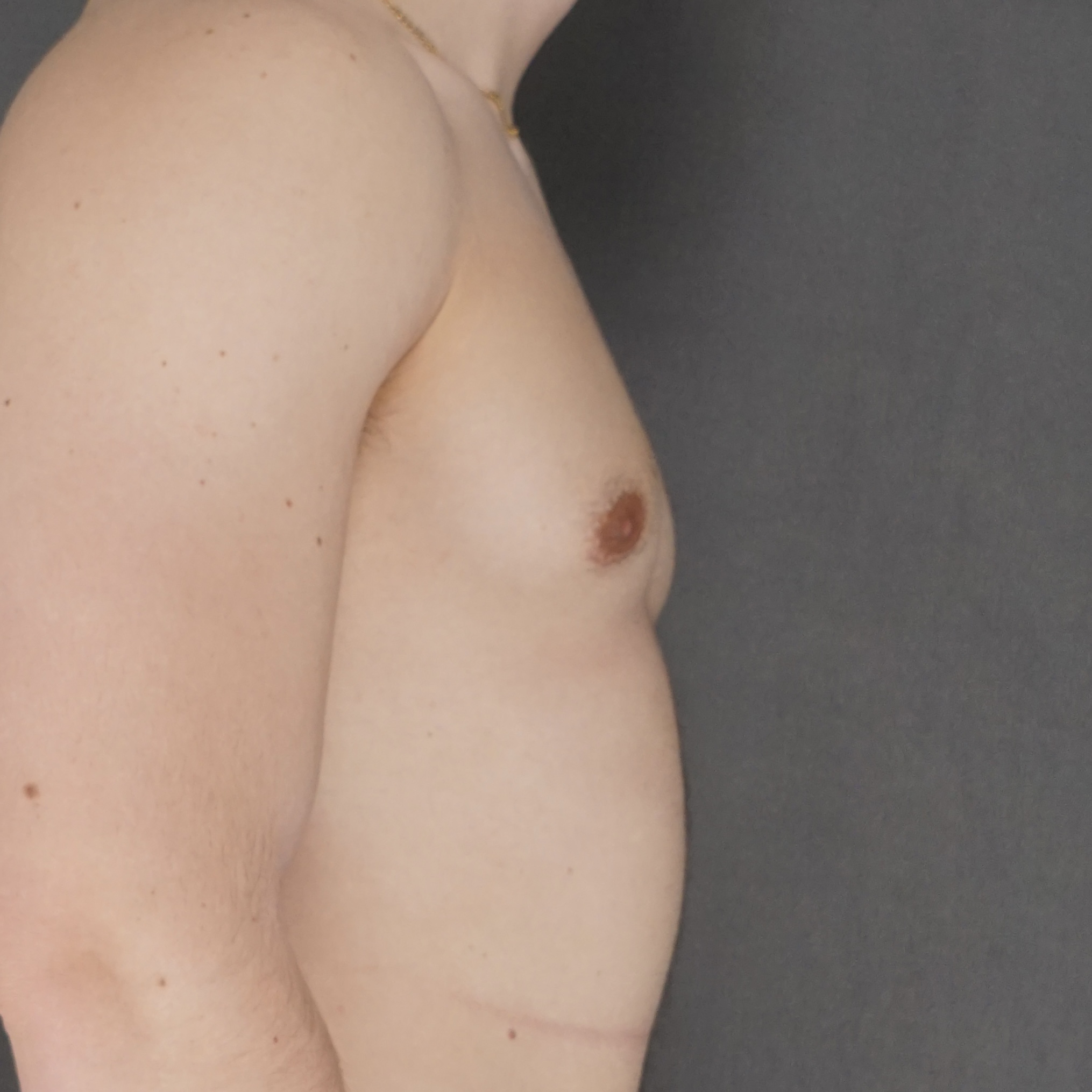 Gynecomastia Surgery after — Dr. Marc Elkowitz