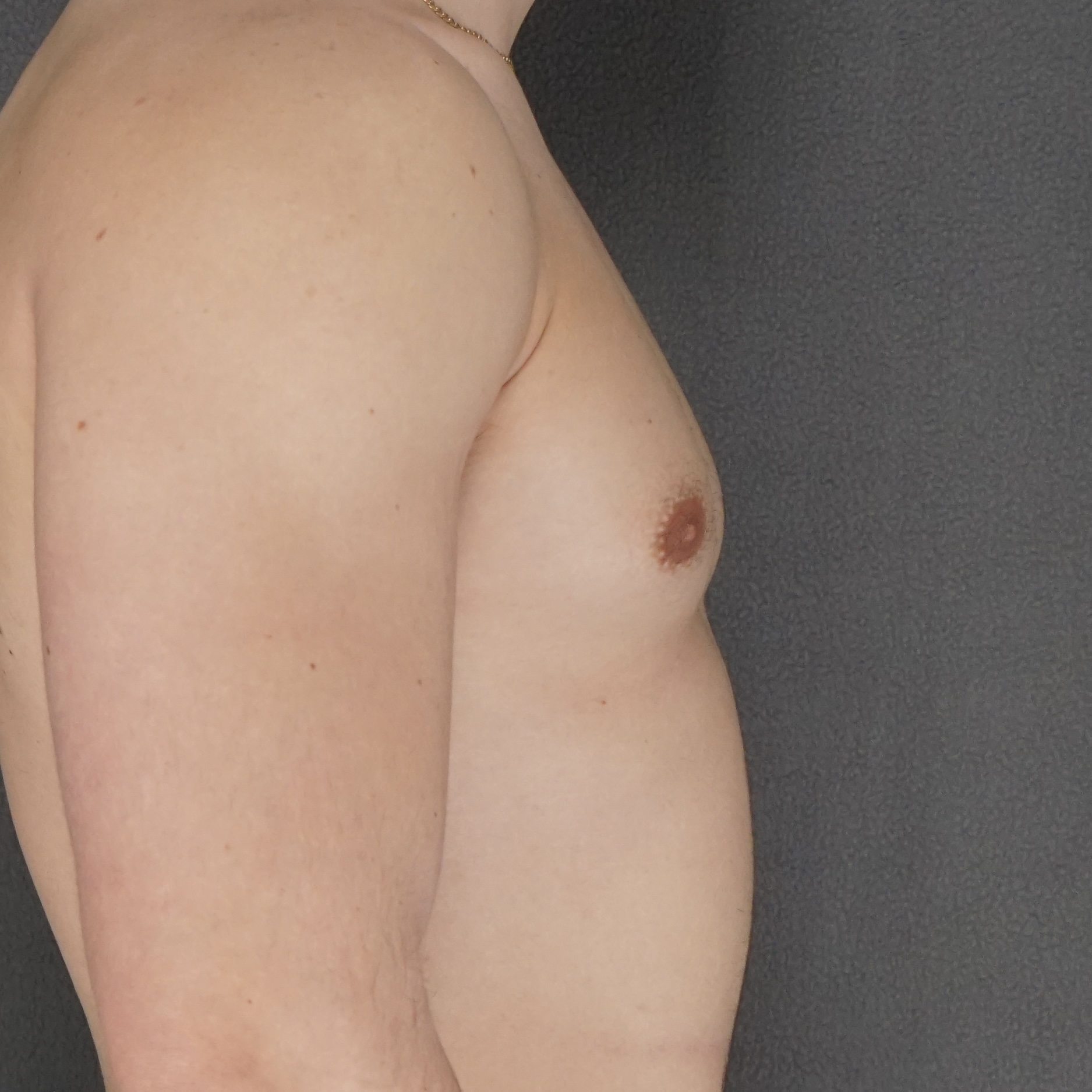 Gynecomastia Surgery before — Dr. Marc Elkowitz