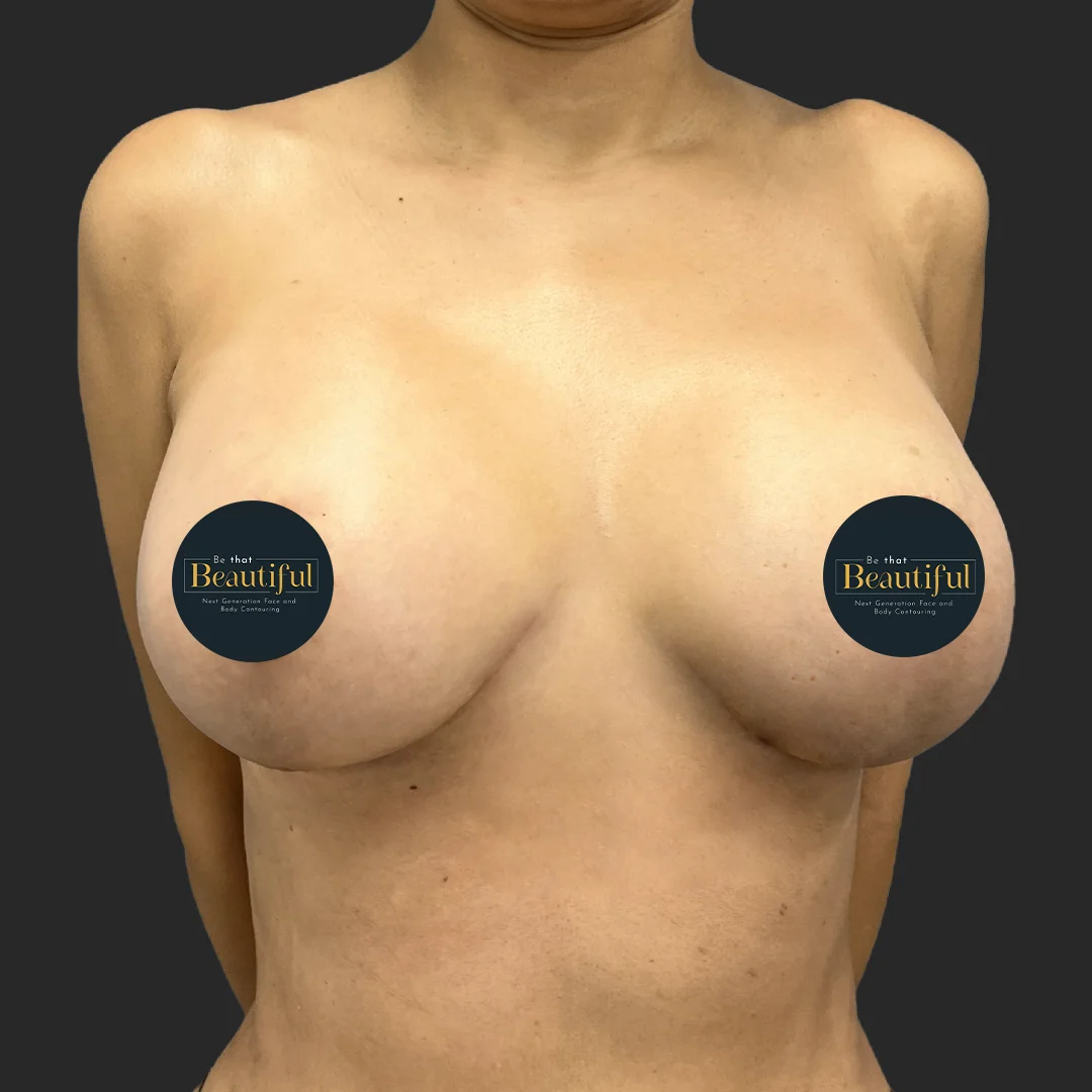 Procedure before and after - after