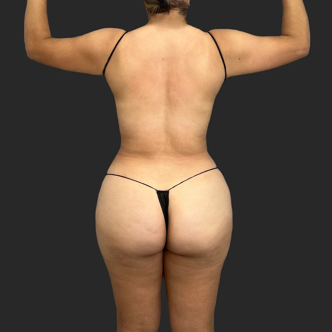 Bbl before and after - after