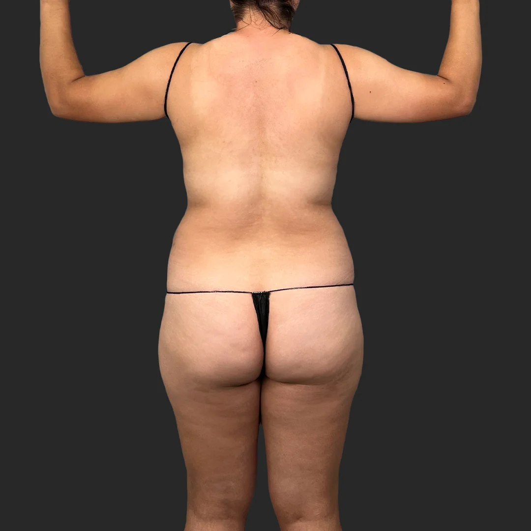 Bbl before and after - before