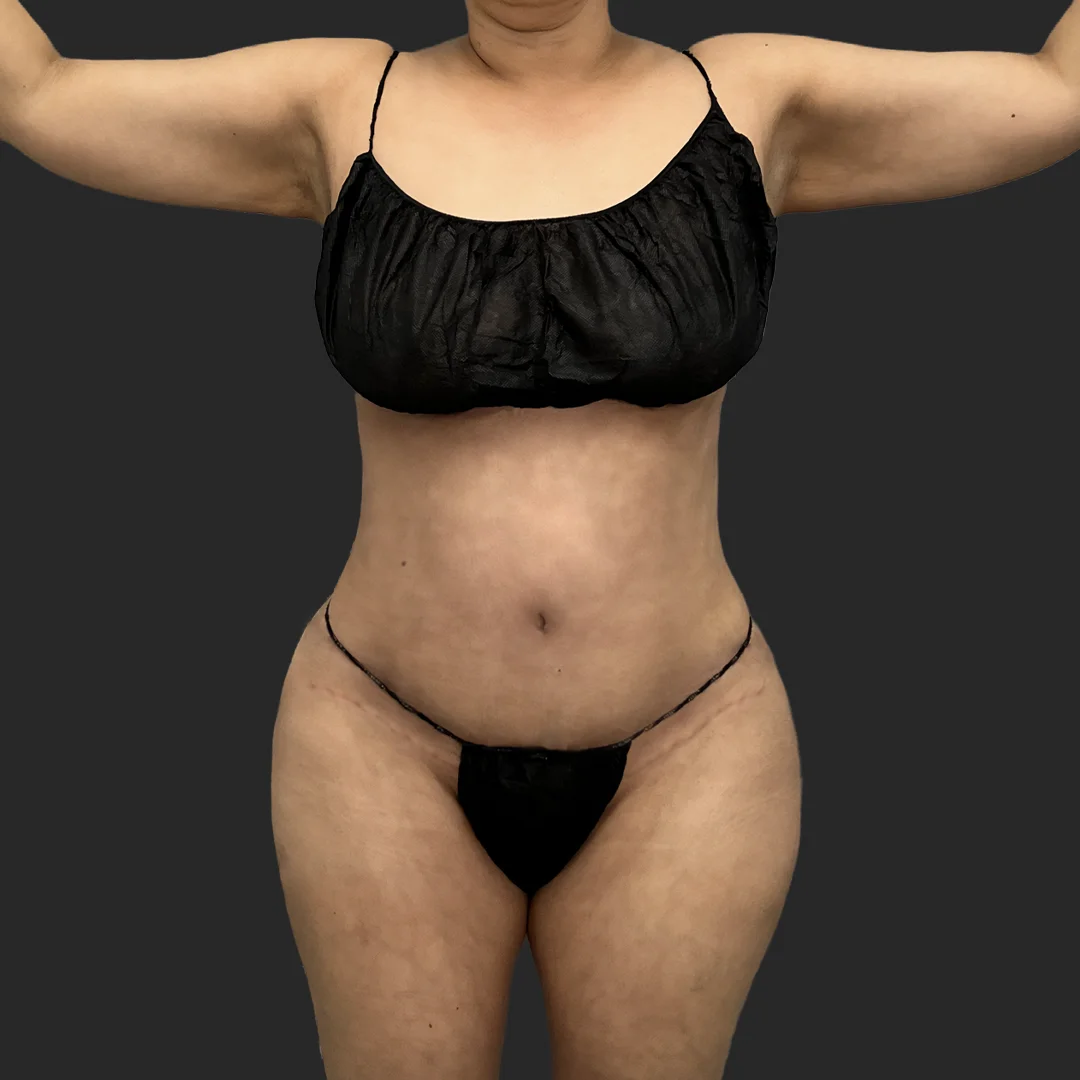 Procedure before and after - after