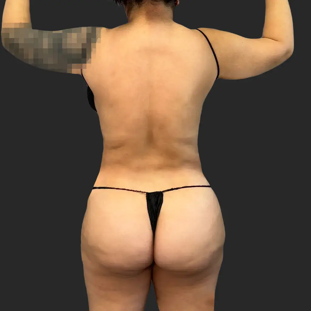 Procedure before and after - before