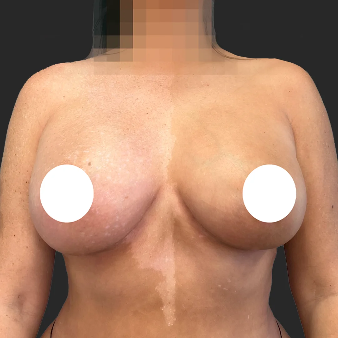 Procedure before and after - after