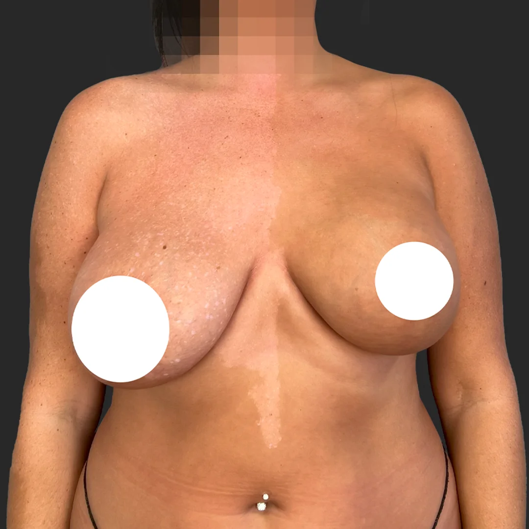 Procedure before and after - before