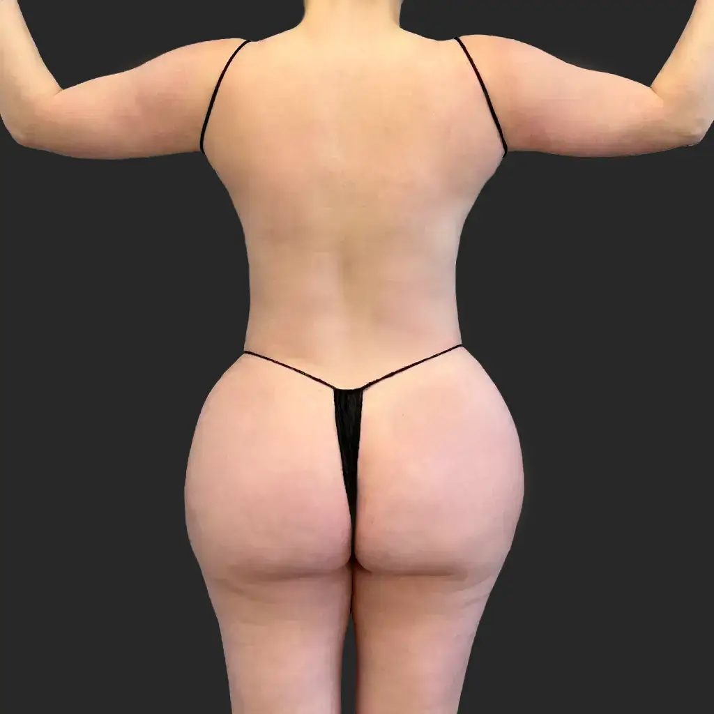Tummy Tuck before and after - after
