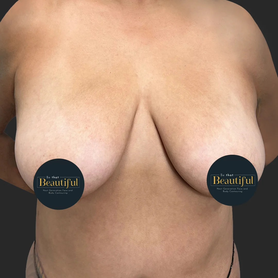 Procedure before and after - before