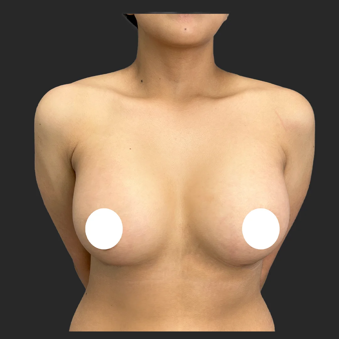 Procedure before and after - after