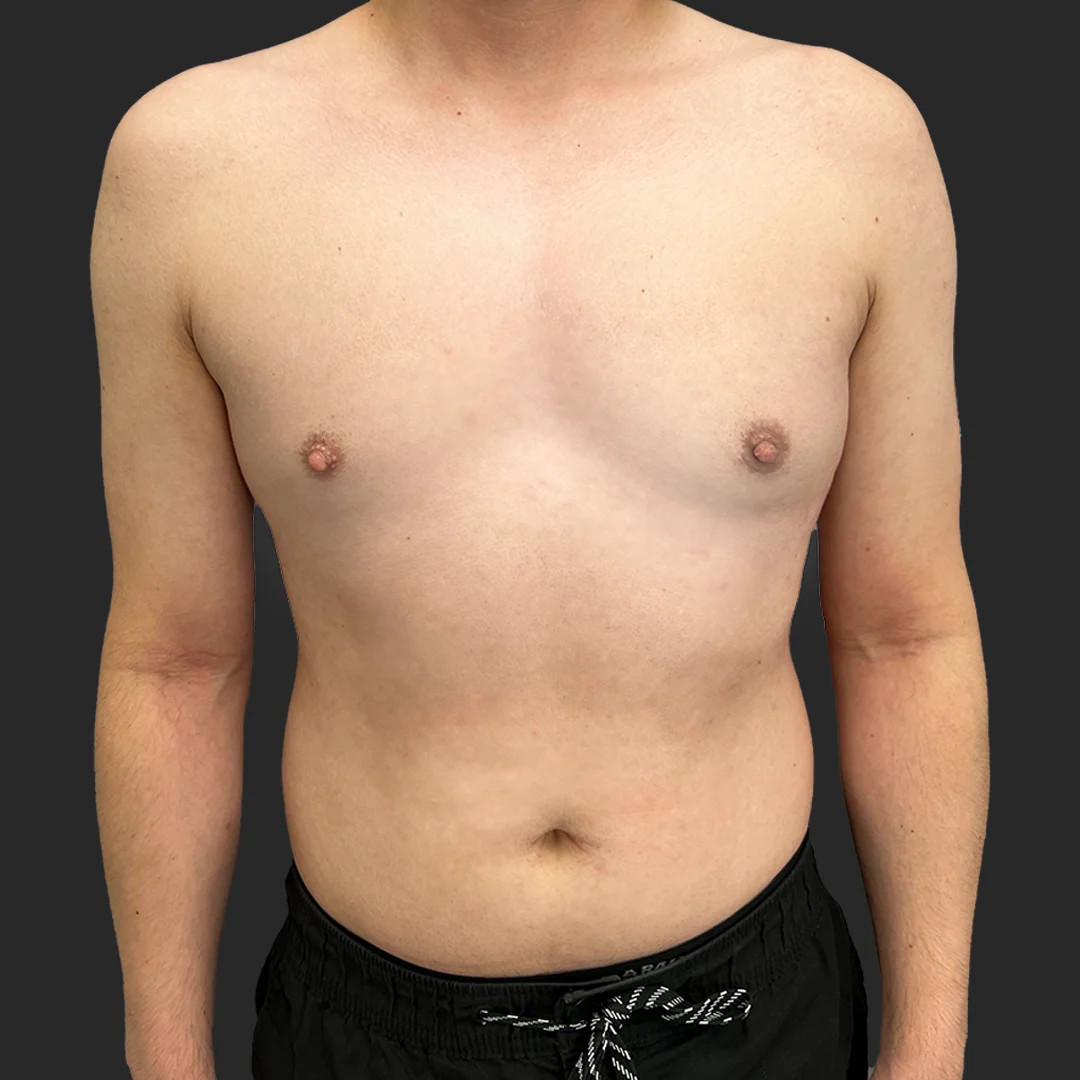 Procedure before and after - after