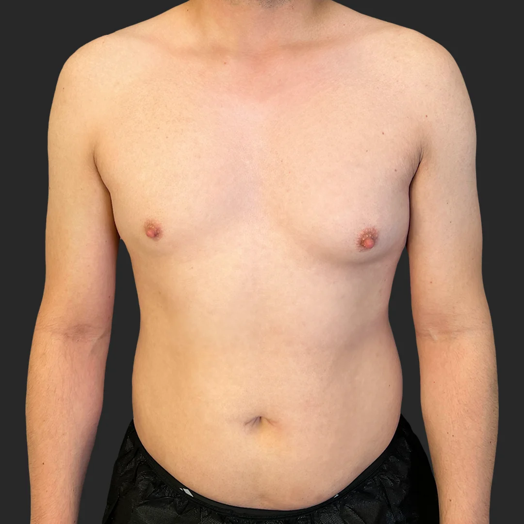 Procedure before and after - before
