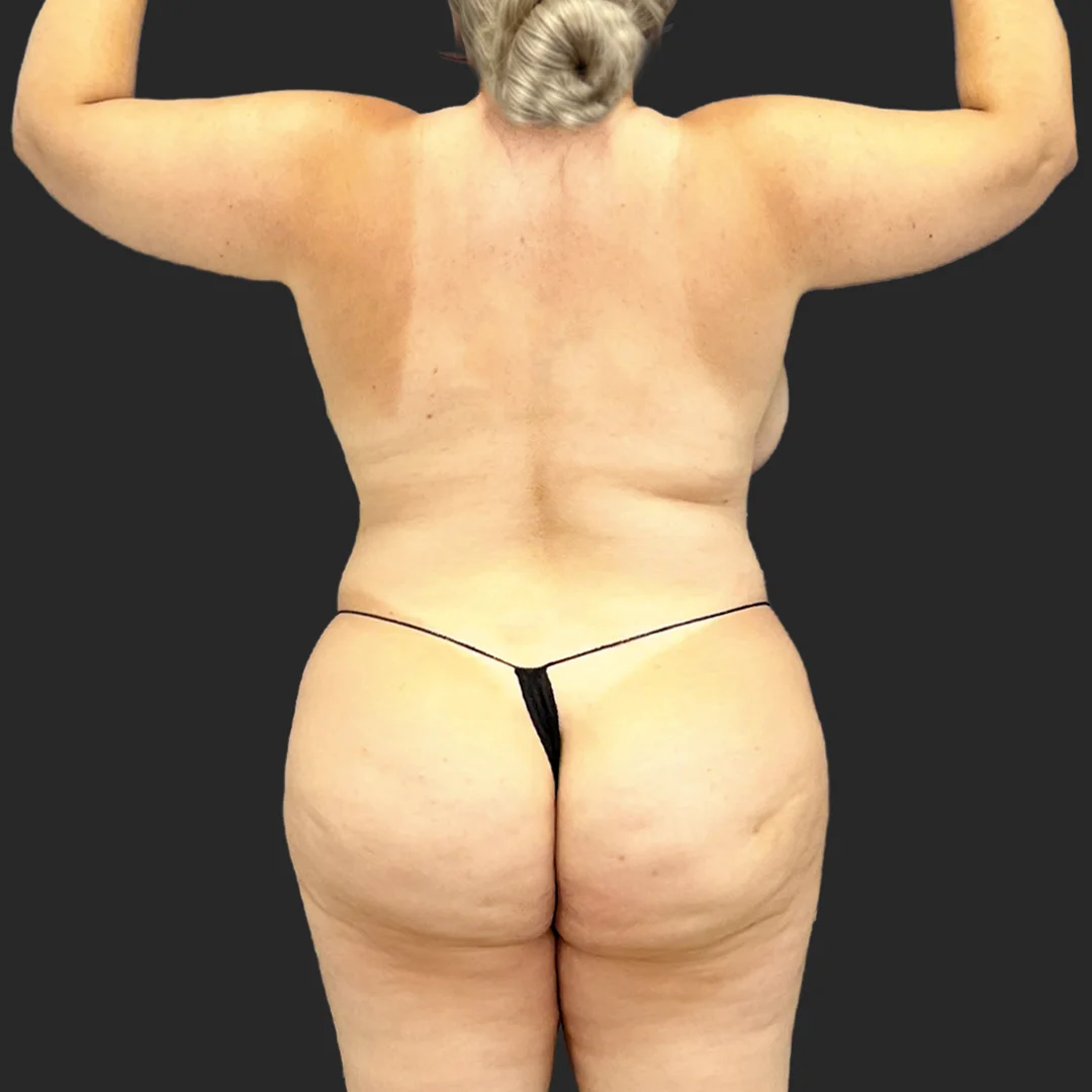 Procedure before and after - before