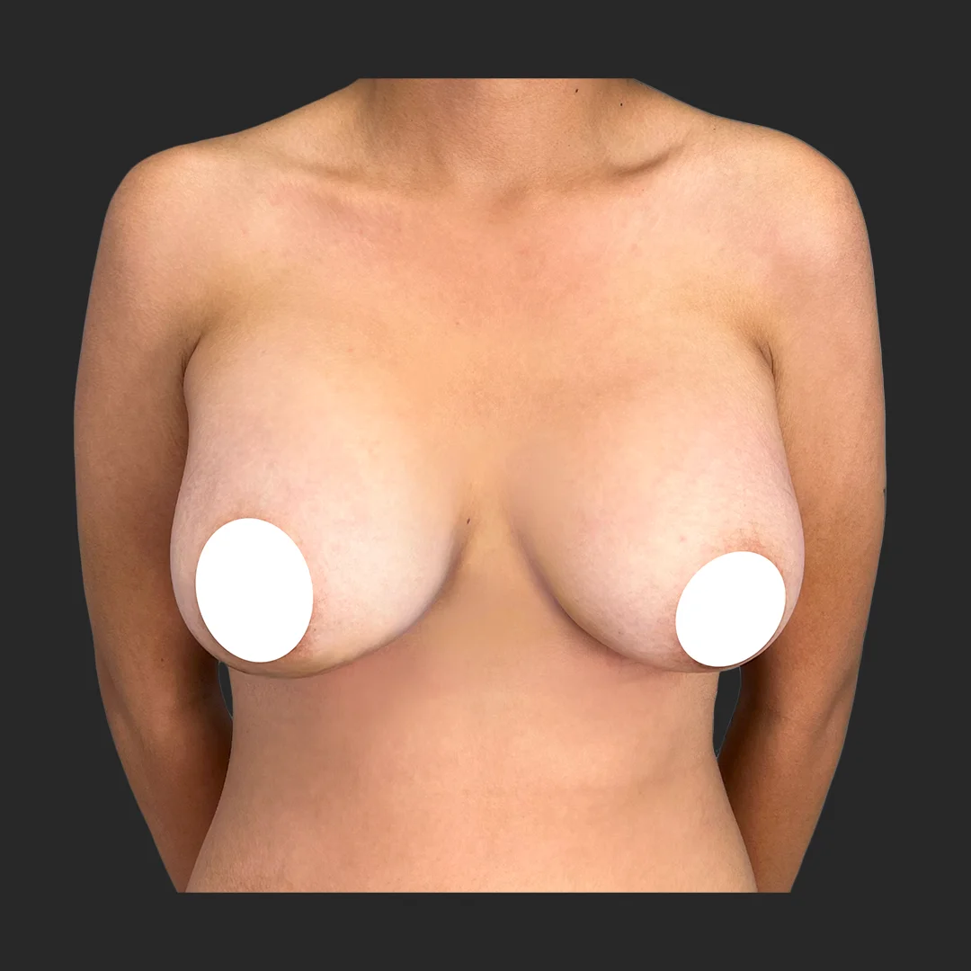 Procedure before and after - after