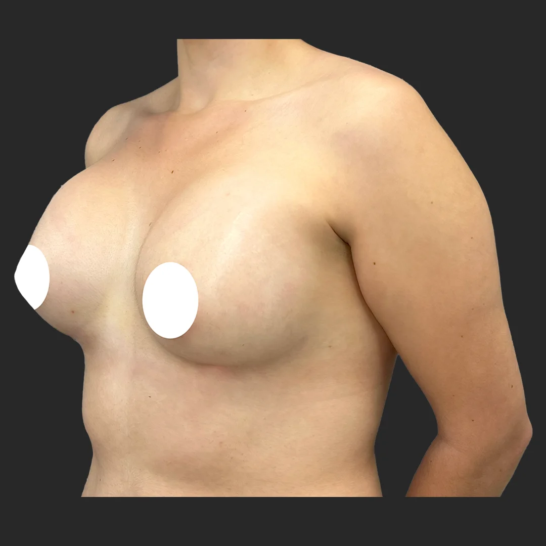 Tummy Tuck before and after - after