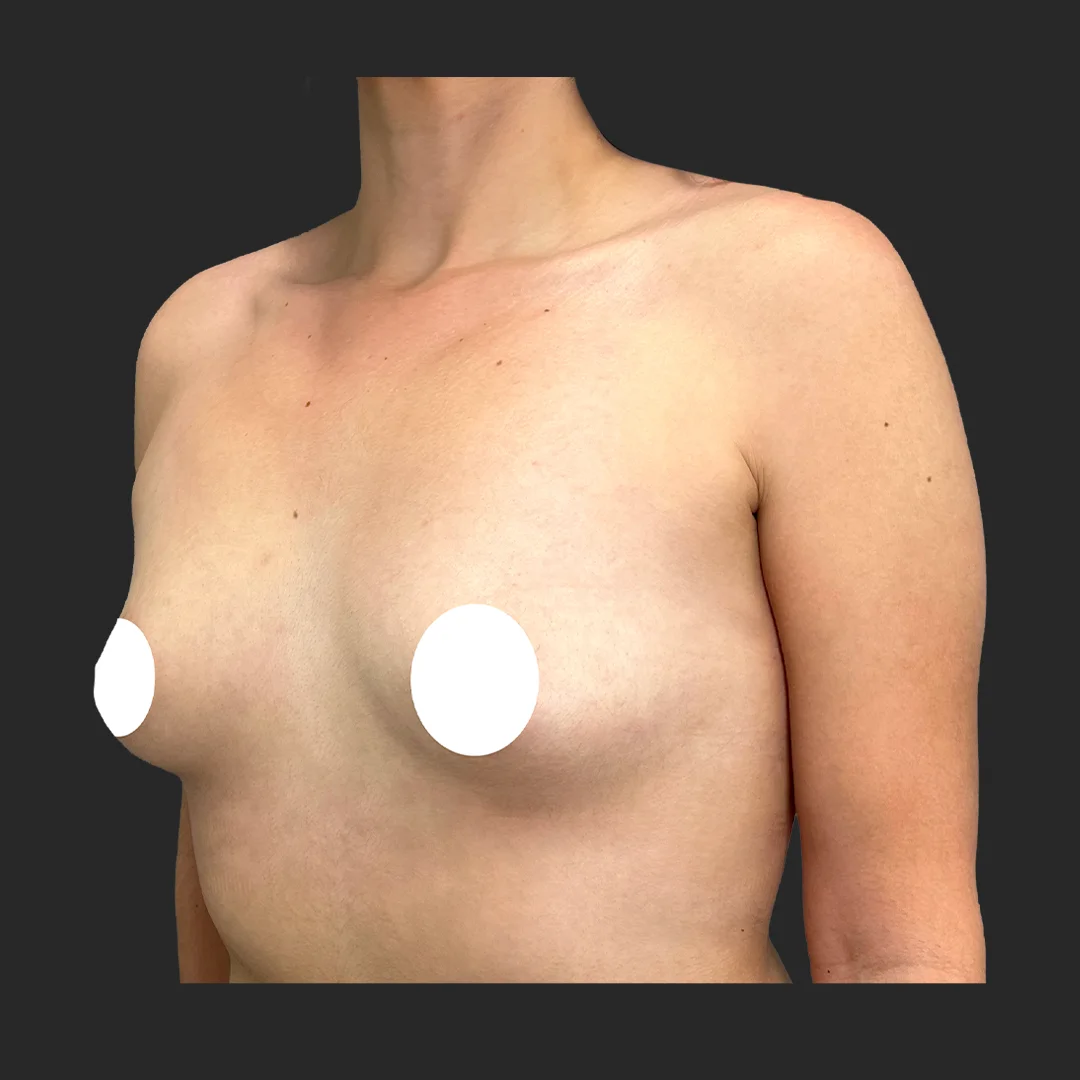Tummy Tuck before and after - before