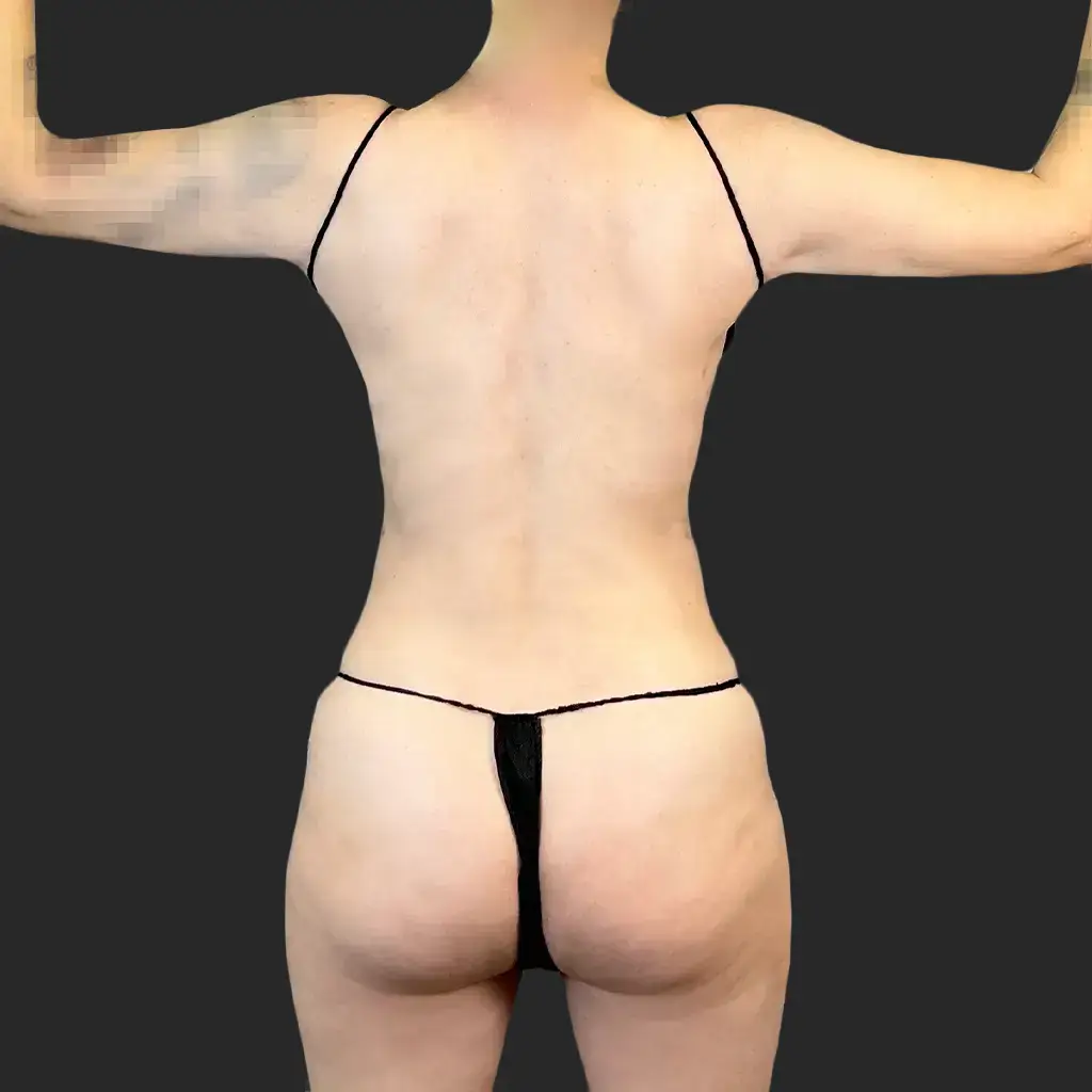 Procedure before and after - before