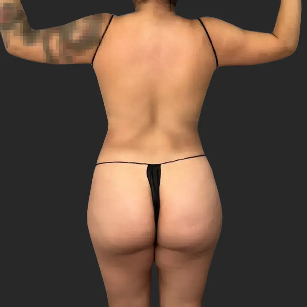 Procedure before and after - before