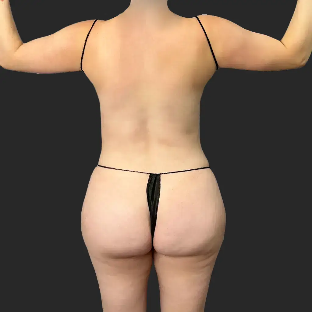 Tummy Tuck before and after - before