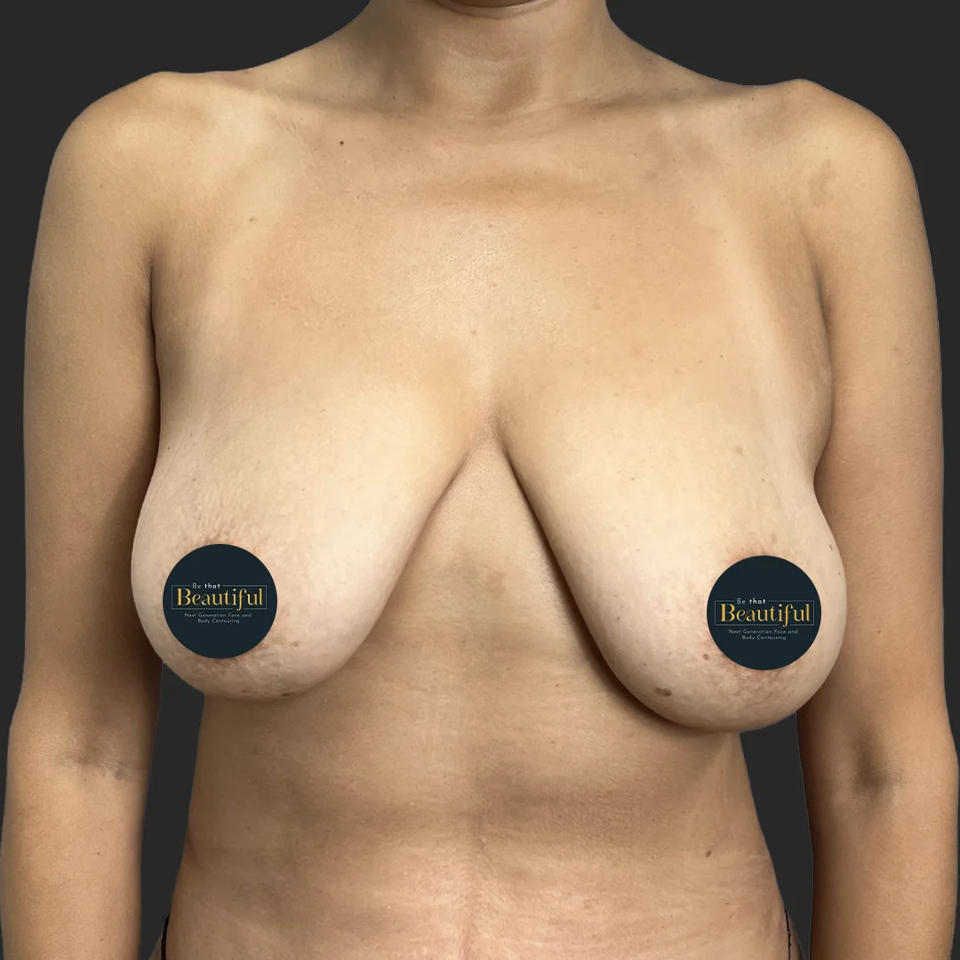 Procedure before and after - before