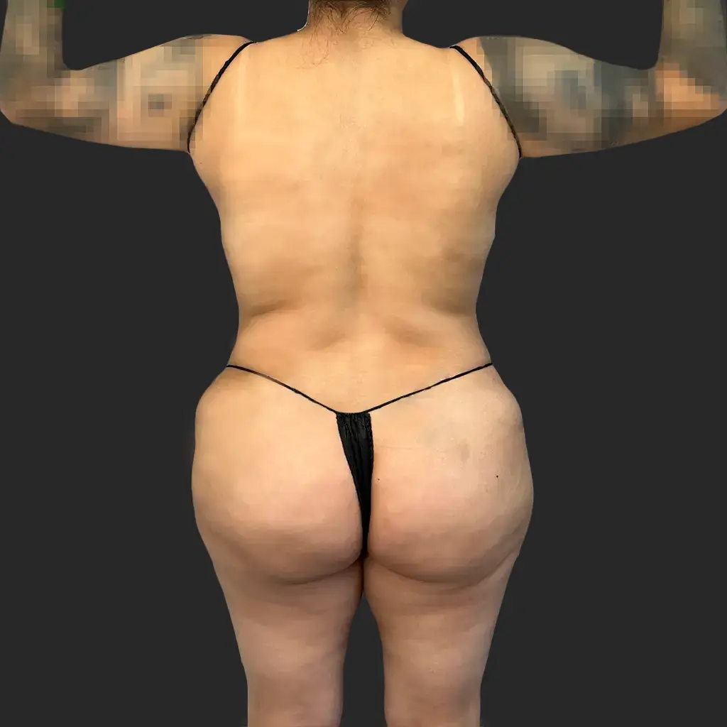 Procedure before and after - before