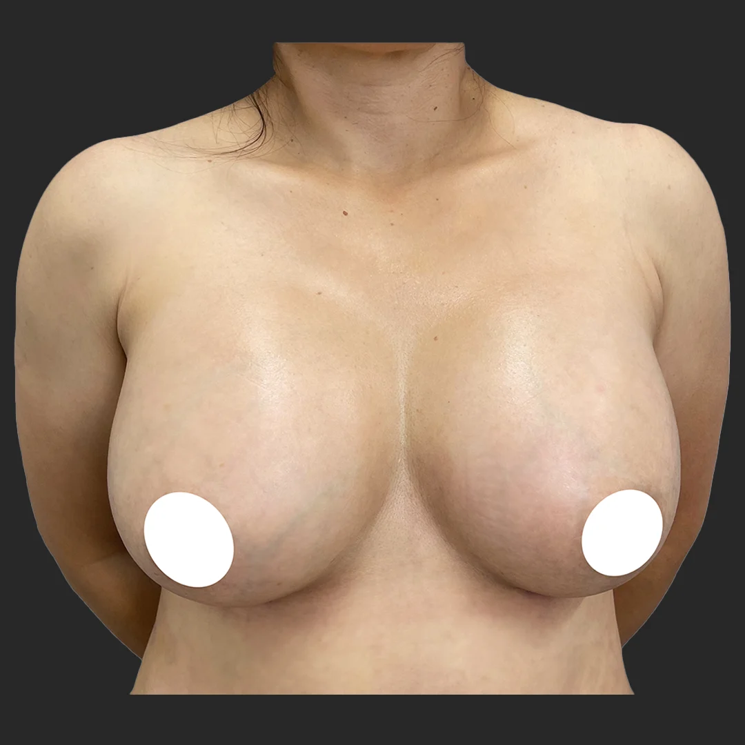 Procedure before and after - after