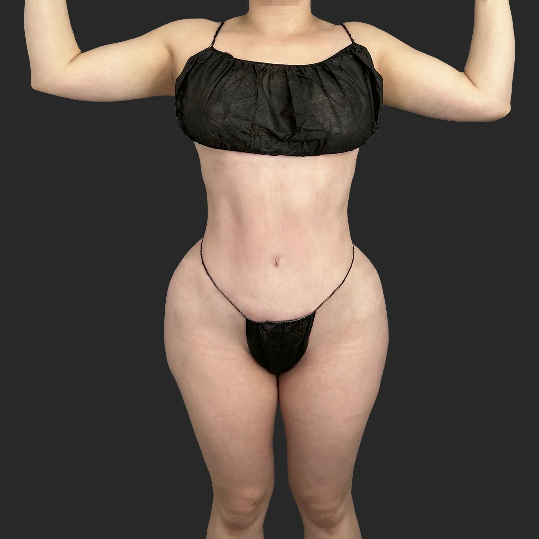 Bbl before and after - after