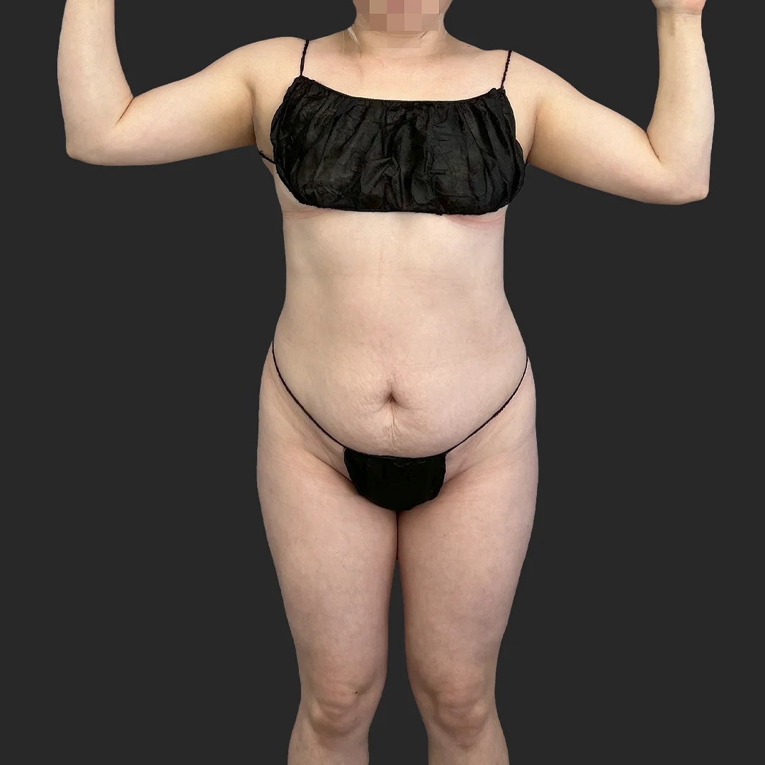 Bbl before and after - before