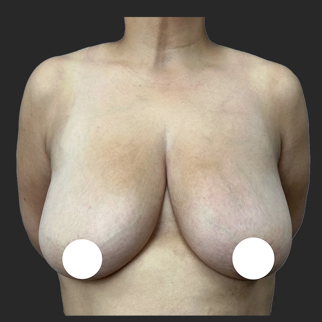 Procedure before and after - before