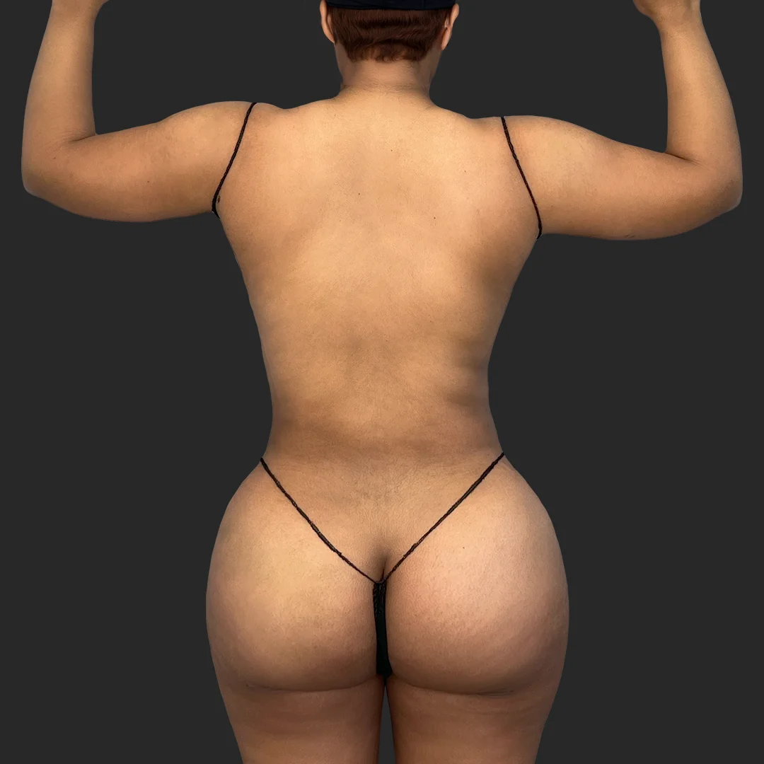 Bbl before and after - after