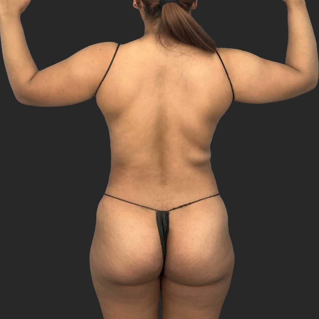 Bbl before and after - before