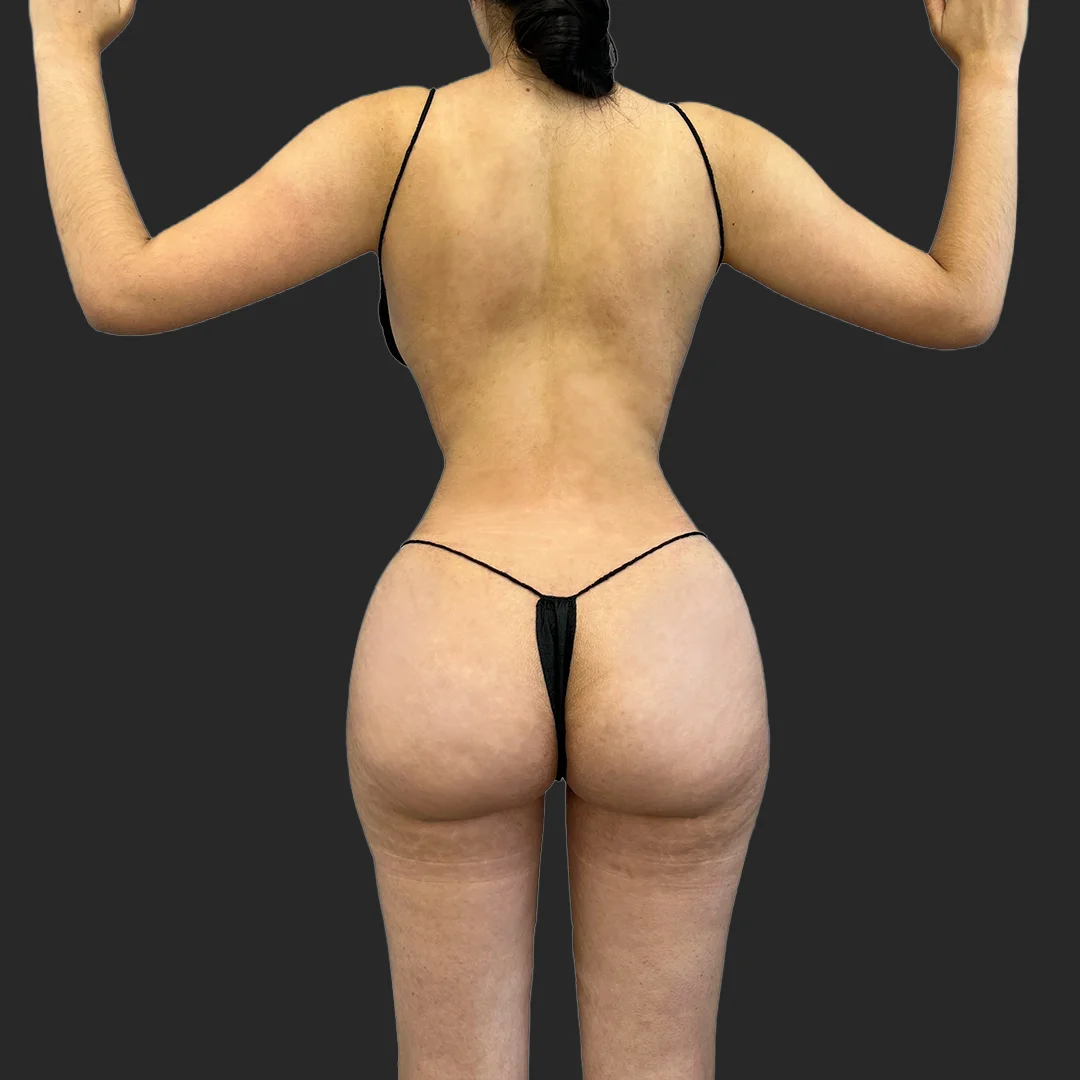 Tummy Tuck before and after - after