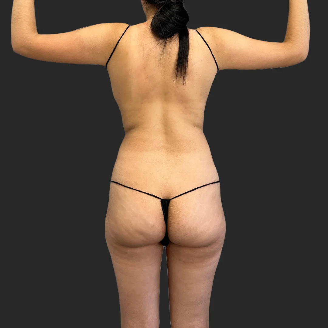 Tummy Tuck before and after - before